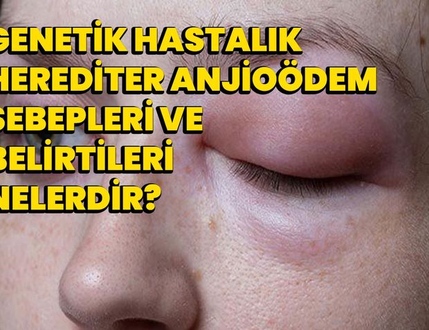 Genetik Hastalık Herediter Anjioödem: